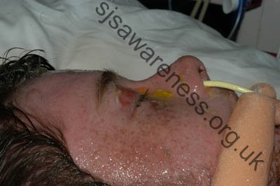24 Year old male in early stage of Toxic Epidermal Necrolysis Syndrome with severe Ocular involvement. Approximately 4 days into reaction. (9)